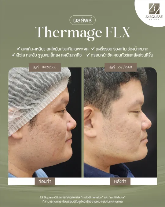 ผลลัพธ์หลังทำ Thermage รักษาสิว