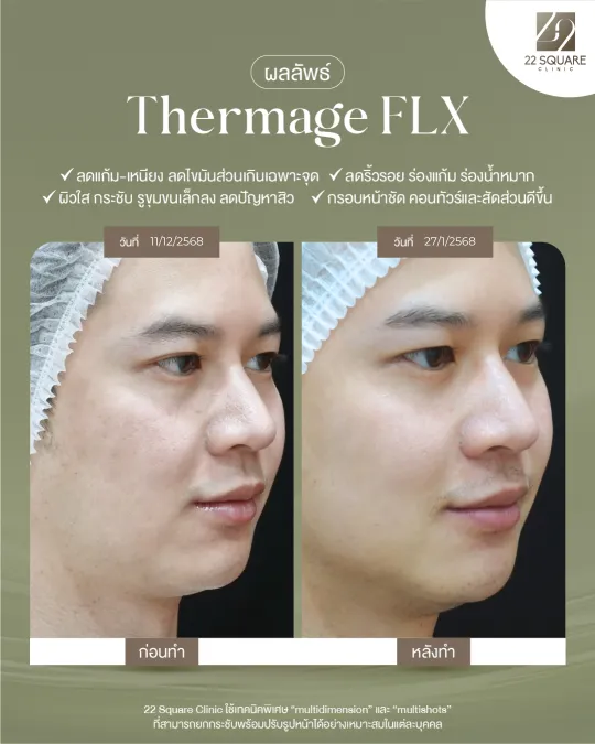 ผลลัพธ์หลังทำ Thermage รักษาสิว