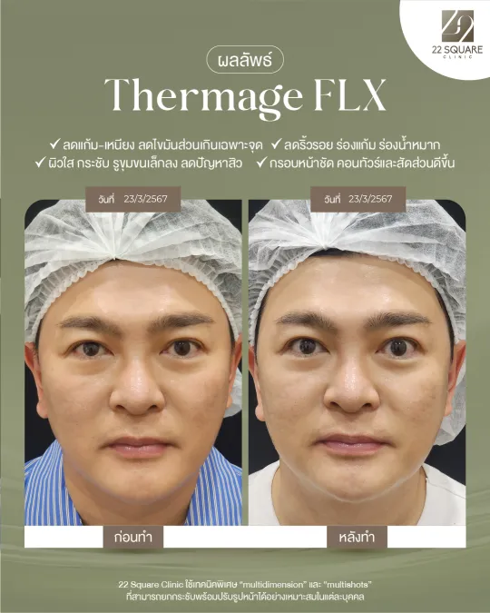ผลลัพธ์หลังทำ Thermage รักษาสิว