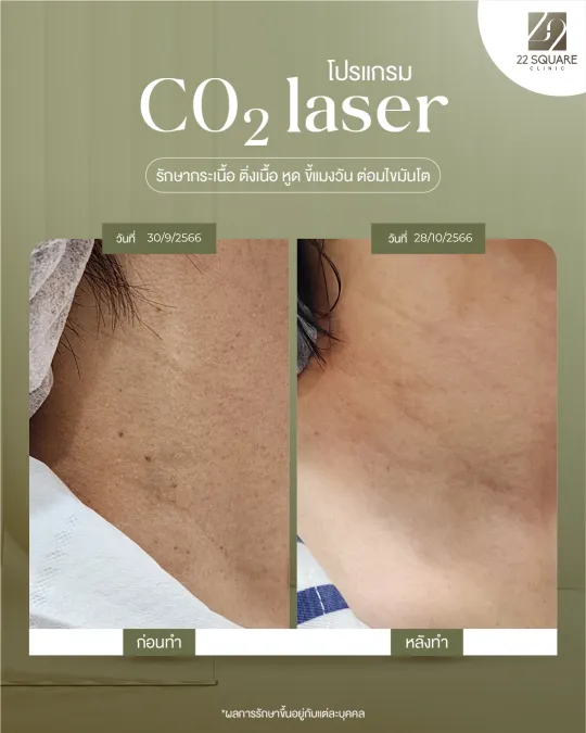 ภาพแสดงไฝและกระเนื้อหลายจุดบนลำคอ | 22 Square Clinic