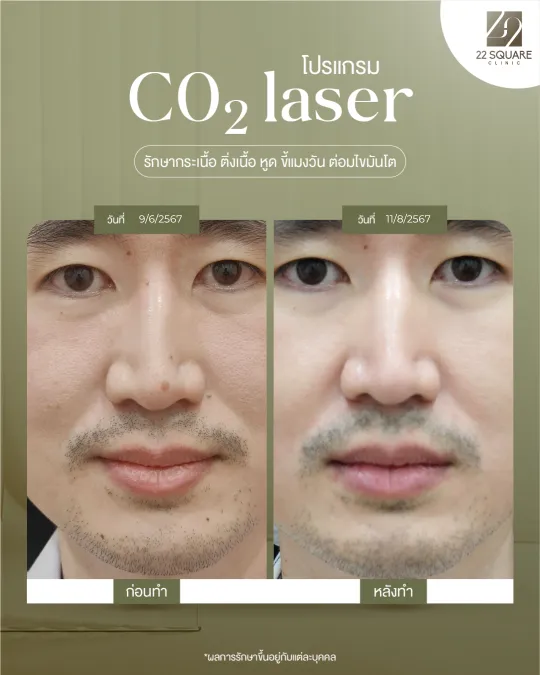 รักษาไฝ กระเนื้อ ติ่งเนื้อด้วย CO2 Laser โดยแพทย์เฉพาะทาง | 22 Square Clinic