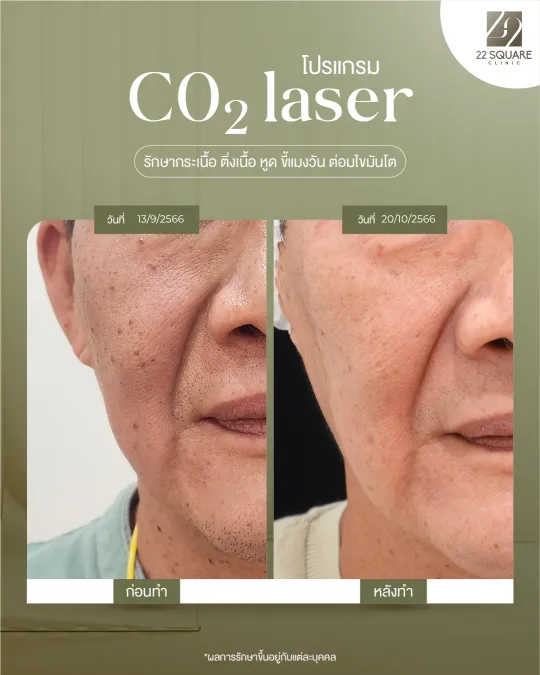 รักษาไฝ กระเนื้อ ติ่งเนื้อด้วย CO2 Laser โดยแพทย์เฉพาะทาง | 22 Square Clinic