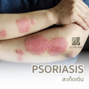 ภาพโรคสะเก็ดเงินบริเวณแขน พร้อมข้อความ PSORIASIS และโลโก้คลินิก