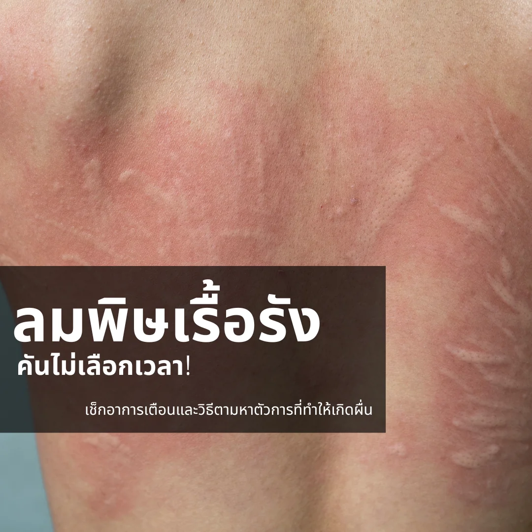 ลักษณะผื่นลมพิษเรื้อรัง ผื่นนูนแดงคัน อาการ Chronic Urticaria