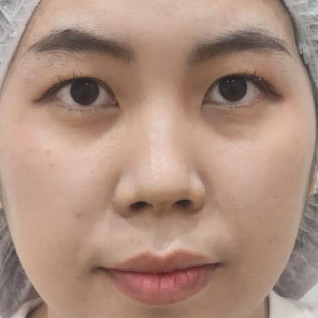 review1040_RV-Filler ใต้ตา1 review1040_RV-Filler ใต้ตา1